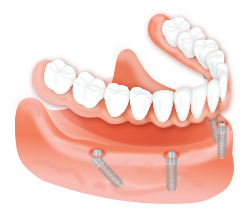 Frisco Implant-Supported Overdentures