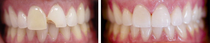 Porcelain Veneers Before and After Photo